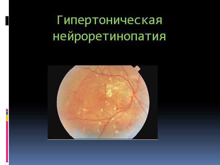 Гипертоническая нейроретинопатия 