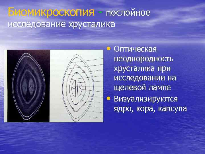 Биомикроскопия - послойное исследование хрусталика • Оптическая • неоднородность хрусталика при исследовании на щелевой