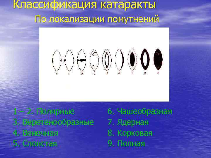 Классификация катаракты По локализации помутнений 1 – 2. Полярные 3. Веретенообразные 4. Венечная 5.