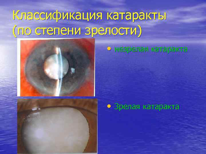 Классификация катаракты (по степени зрелости) • незрелая катаракта • Зрелая катаракта 