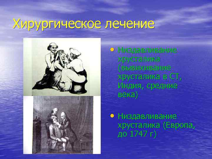 Хирургическое лечение • Низдавливание хрусталика (вывихивание хрусталика в СТ, Индия, средние века) • Низдавливание