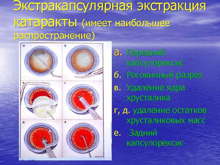 Экстракапсулярная экстракция катаракты (имеет наибольшее распространение) a. Передний капсулорексис б. Роговичный разрез в. Удаление