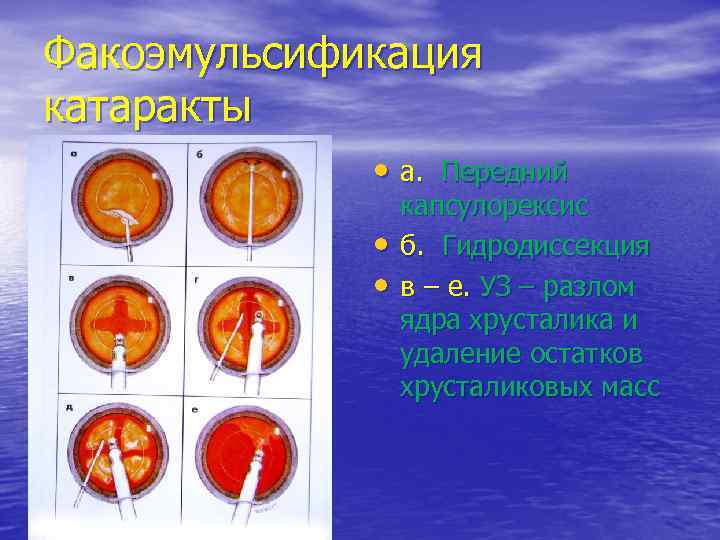 Факоэмульсификация катаракты • а. Передний • • капсулорексис б. Гидродиссекция в – е. УЗ