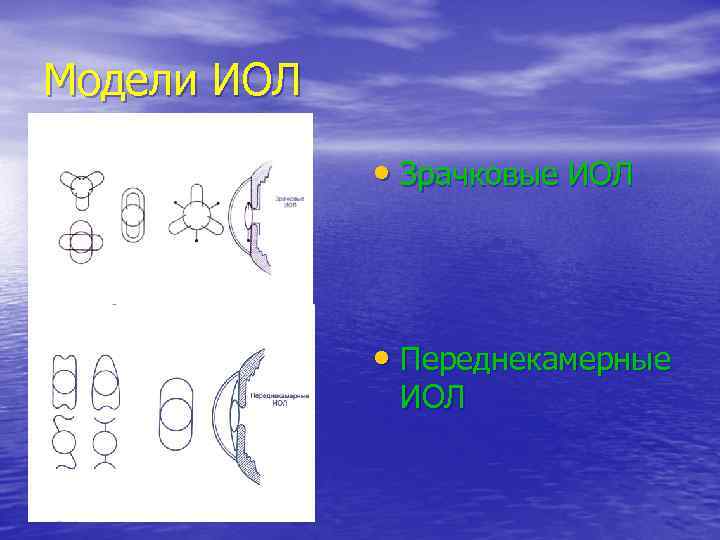 Модели ИОЛ • Зрачковые ИОЛ • Переднекамерные ИОЛ 