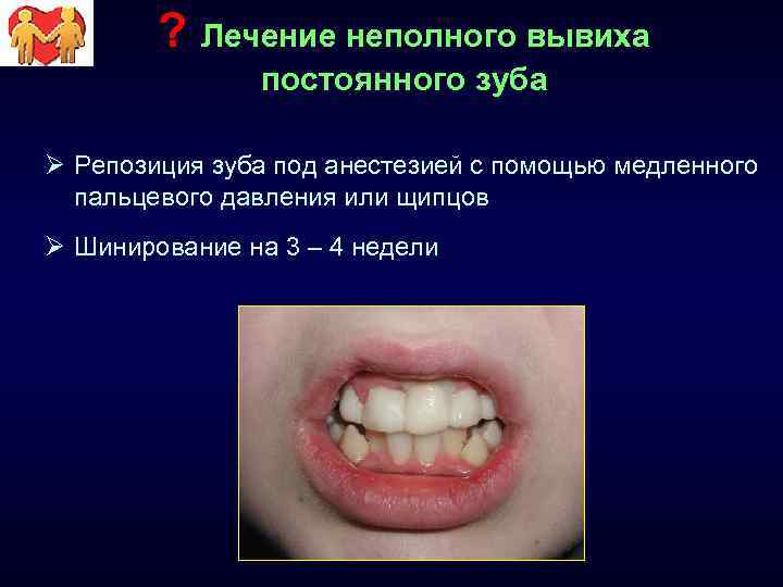 ? Лечение неполного вывиха постоянного зуба Ø Репозиция зуба под анестезией с помощью медленного