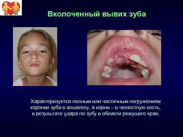Вколоченный вывих зуба Характеризуется полным или частичным погружением коронки зуба в альвеолу, а корня