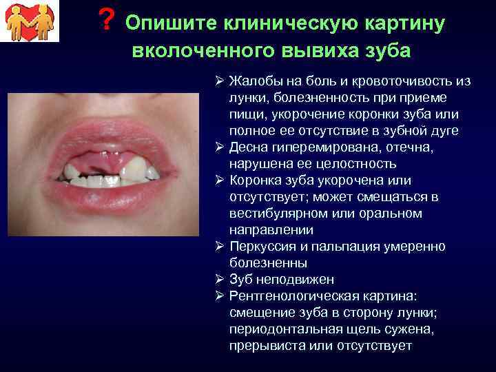 ? Опишите клиническую картину вколоченного вывиха зуба Ø Жалобы на боль и кровоточивость из