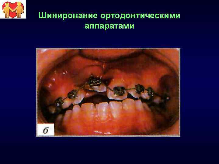 Шинирование ортодонтическими аппаратами 