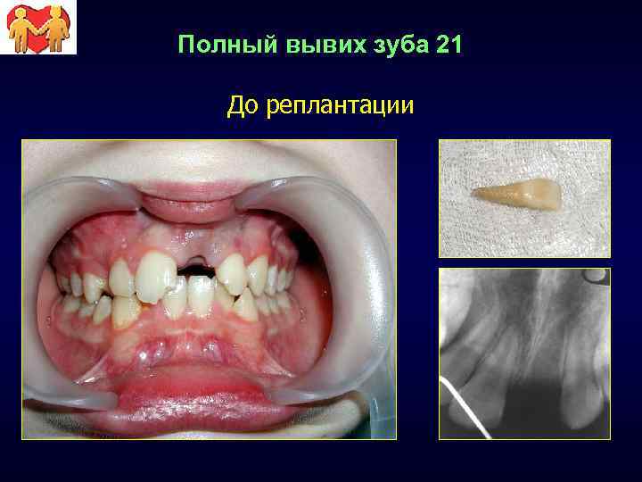 Полный вывих зуба 21 До реплантации 