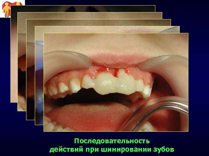 Последовательность действий при шинировании зубов 