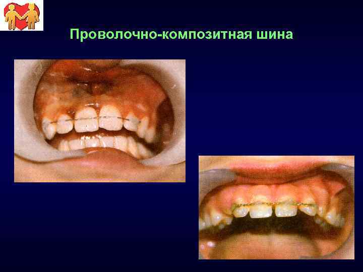 Проволочно-композитная шина 