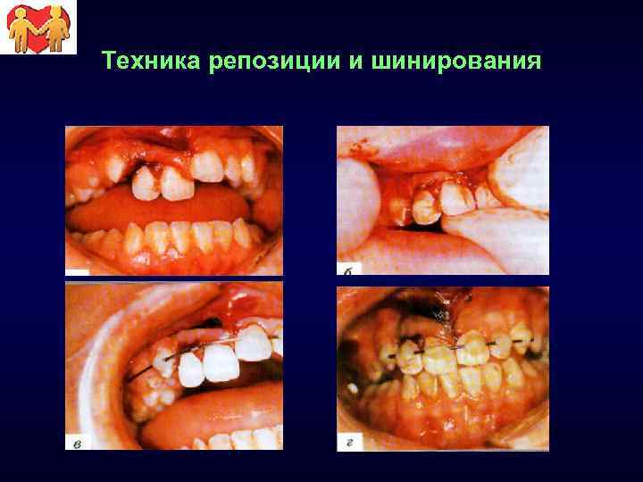 Техника репозиции и шинирования 