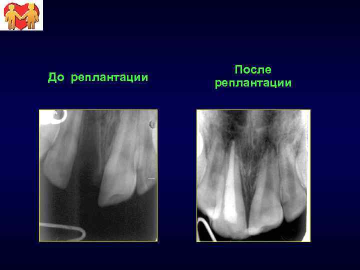 До реплантации После реплантации 
