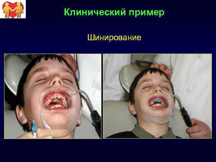 Клинический пример Шинирование 