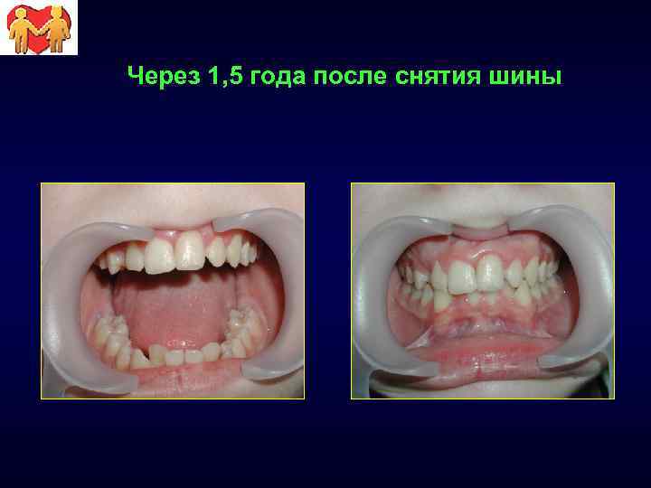Через 1, 5 года после снятия шины 