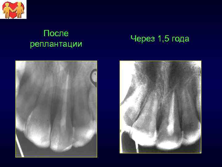 После реплантации Через 1, 5 года 