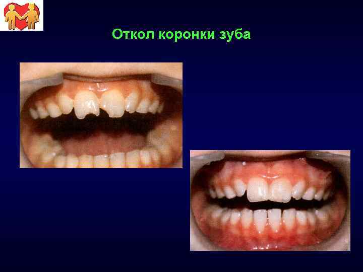 Откол коронки зуба 