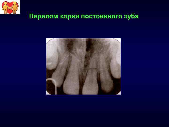 Перелом корня постоянного зуба 