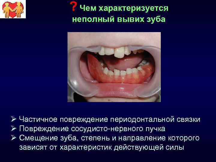 ? Чем характеризуется неполный вывих зуба Ø Частичное повреждение периодонтальной связки Ø Повреждение сосудисто-нервного