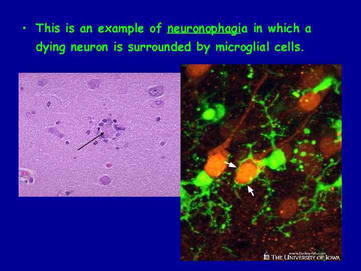 • This is an example of neuronophagia in which a dying neuron is