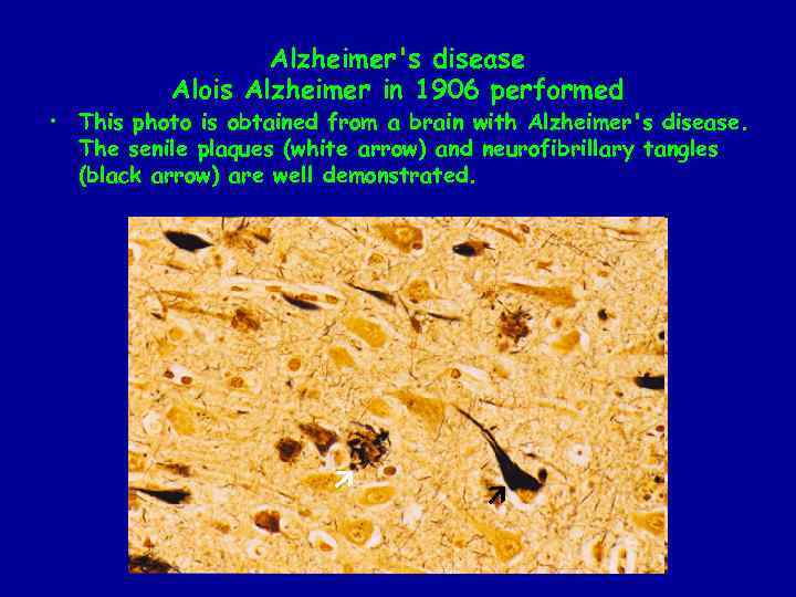 Alzheimer's disease Alois Alzheimer in 1906 performed • This photo is obtained from a