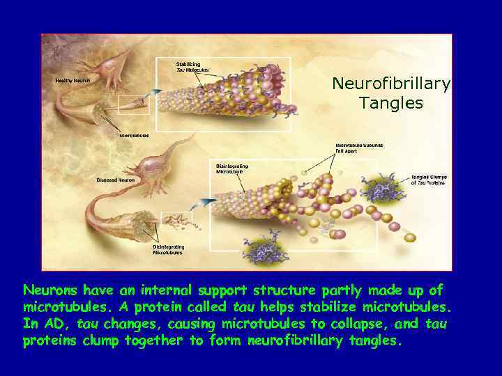 Neurofibrillary Tangles Neurons have an internal support structure partly made up of microtubules. A