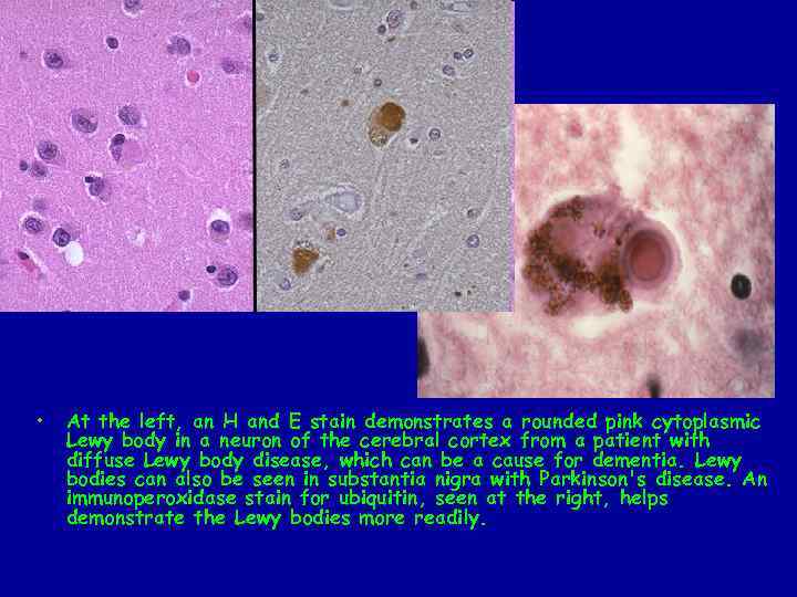  • At the left, an H and E stain demonstrates a rounded pink