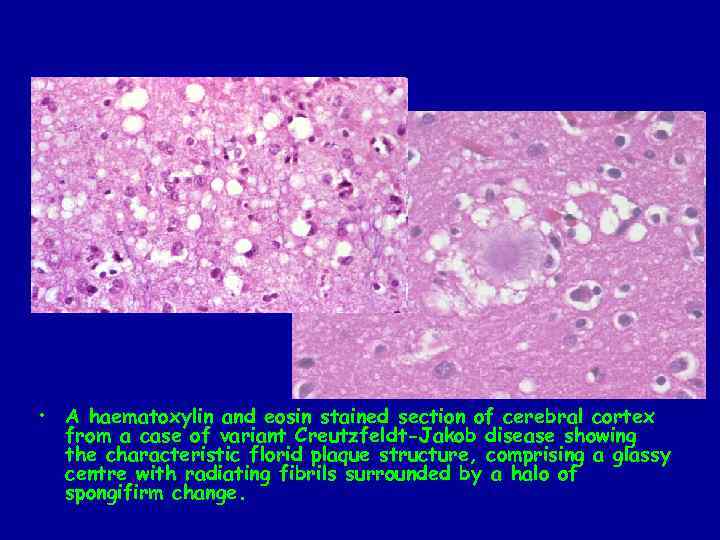  • A haematoxylin and eosin stained section of cerebral cortex from a case