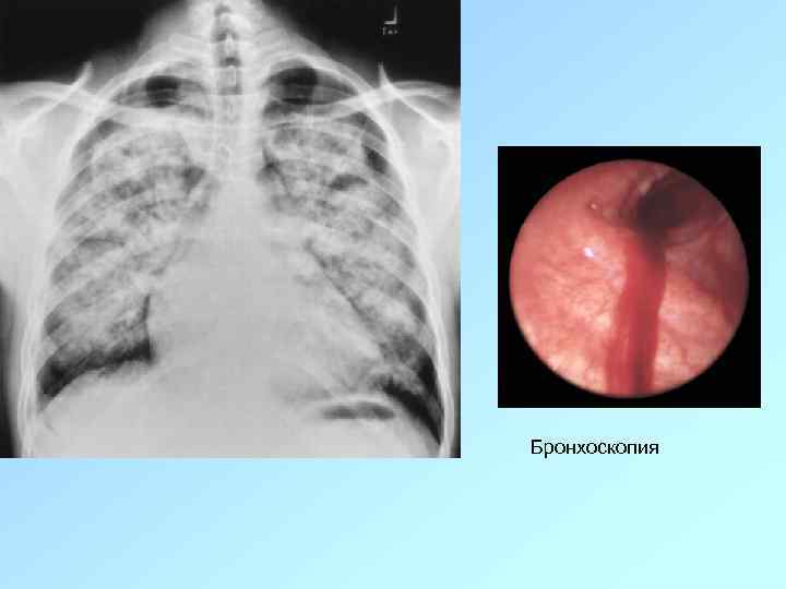 Бронхоскопия 