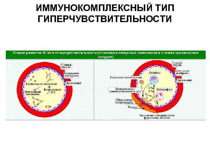 ИММУНОКОМПЛЕКСНЫЙ ТИП ГИПЕРЧУВСТВИТЕЛЬНОСТИ 
