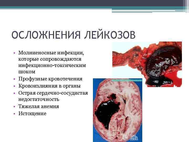 ОСЛОЖНЕНИЯ ЛЕЙКОЗОВ • Молниеносные инфекции, которые сопровождаются инфекционно-токсическим шоком • Профузные кровотечения • Кровоизлияния