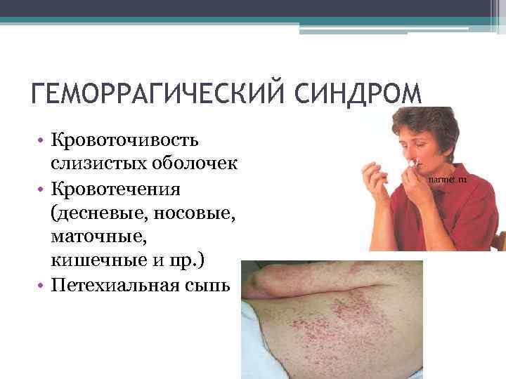 ГЕМОРРАГИЧЕСКИЙ СИНДРОМ • Кровоточивость слизистых оболочек • Кровотечения (десневые, носовые, маточные, кишечные и пр.