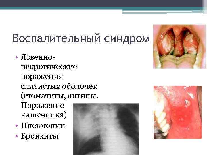 Воспалительный синдром • Язвеннонекротические поражения слизистых оболочек (стоматиты, ангины. Поражение кишечника) • Пневмонии •