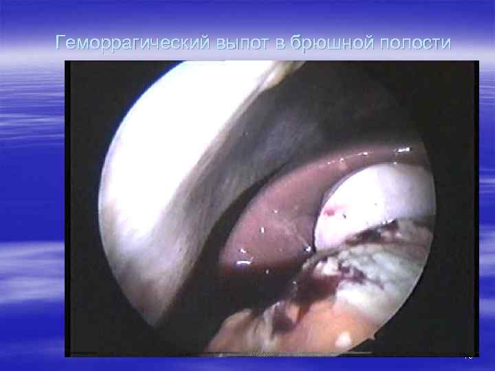 Геморрагический выпот в брюшной полости 15 