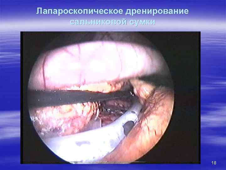Лапароскопическое дренирование сальниковой сумки 18 