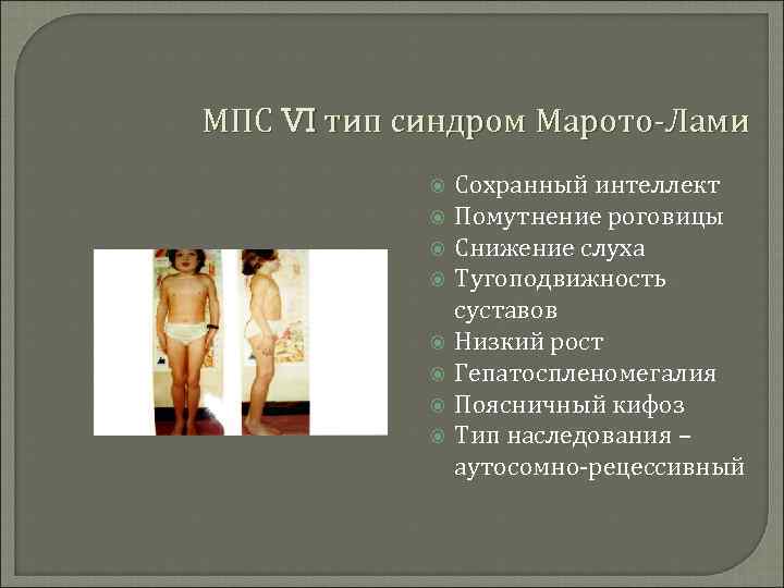 МПС VI тип синдром Марото-Лами Сохранный интеллект Помутнение роговицы Снижение слуха Тугоподвижность суставов Низкий