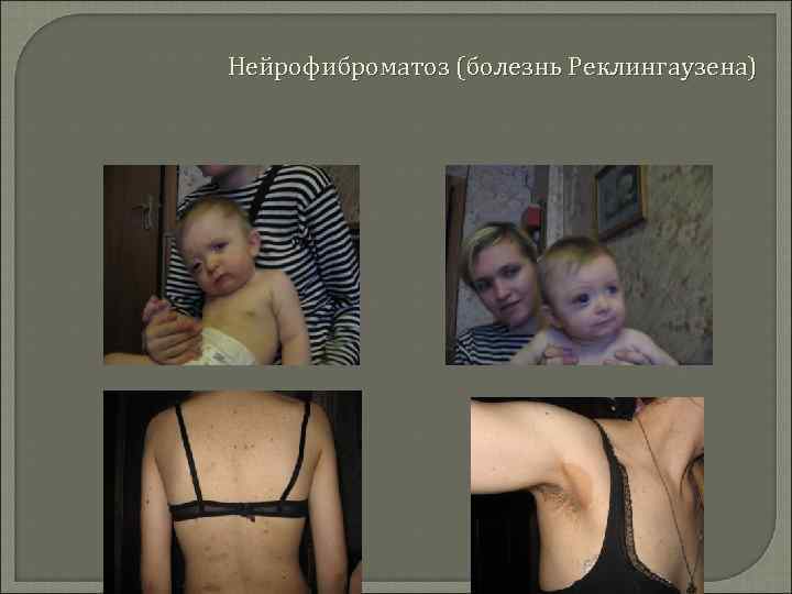 Нейрофиброматоз (болезнь Реклингаузена) 