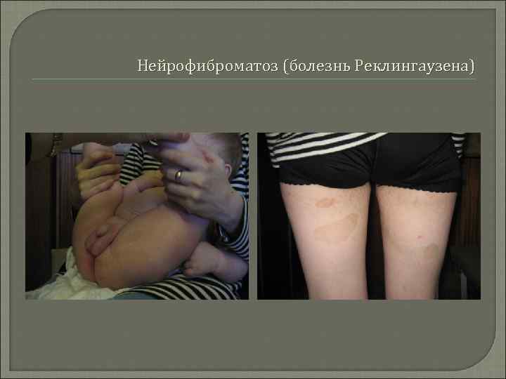 Нейрофиброматоз (болезнь Реклингаузена) 