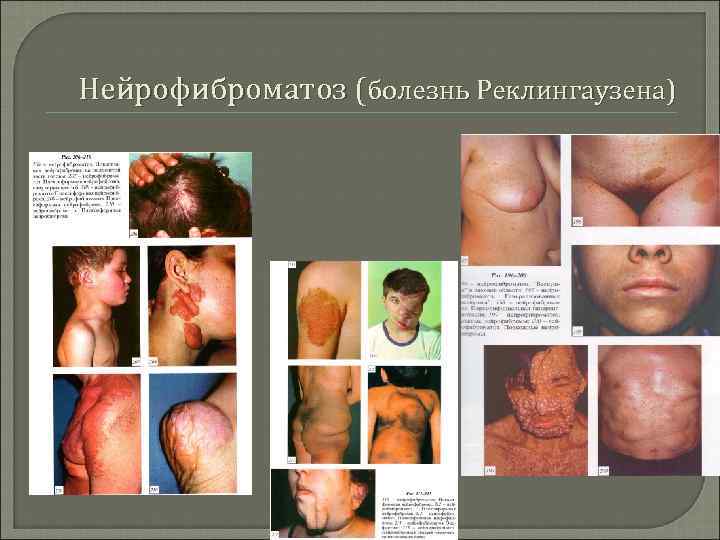 Нейрофиброматоз (болезнь Реклингаузена) 