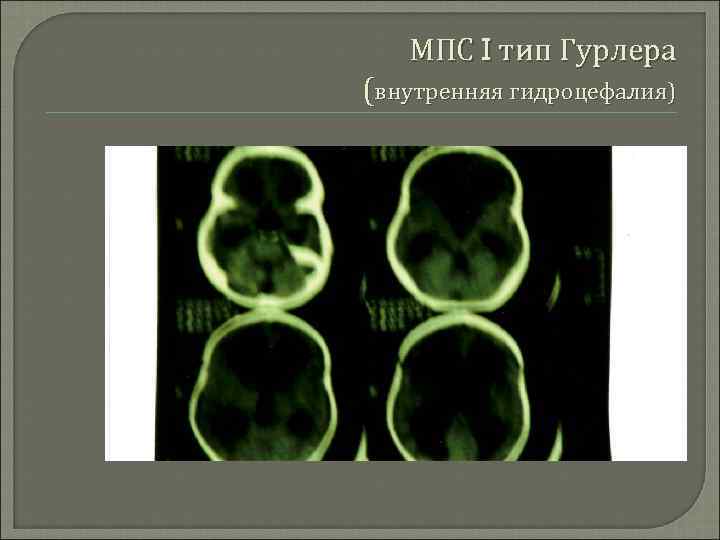 МПС I тип Гурлера (внутренняя гидроцефалия) 