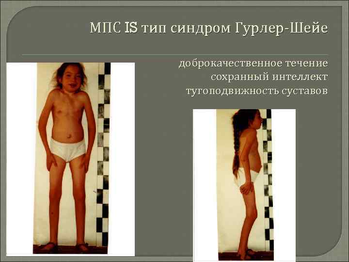МПС IS тип синдром Гурлер-Шейе доброкачественное течение сохранный интеллект тугоподвижность суставов 