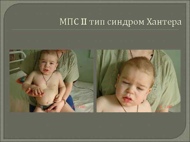 Детей хантер. Синдром Хантера мукополисахаридоз II. Синдром Хантера мукополисахаридоз.