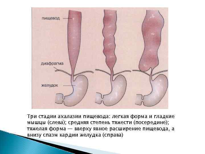 Расширение пищевода