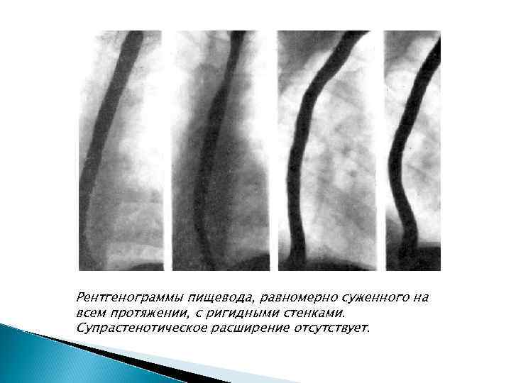 Бронхиальное сужение пищевода обусловлено вдавлением в его стенку