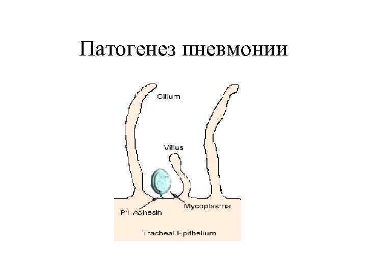 Патогенез пневмонии 