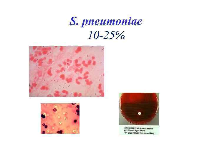 S. pneumoniae 10 -25% 