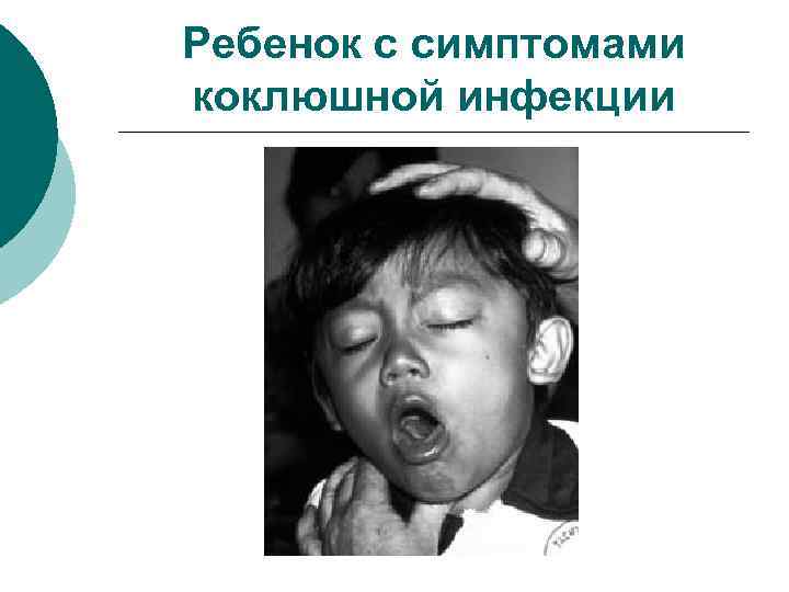 Ребенок с симптомами коклюшной инфекции 