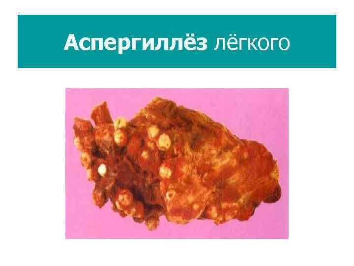 Аспергиллёз лёгкого 