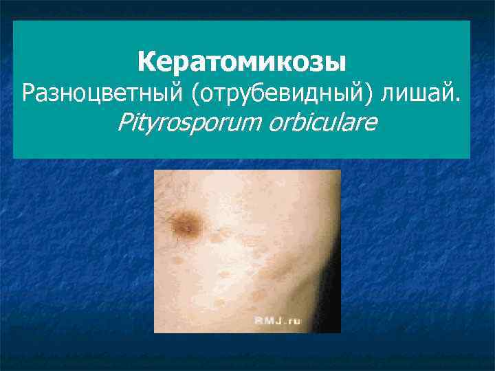 Кератомикозы Разноцветный (отрубевидный) лишай. Pityrosporum orbiculare 