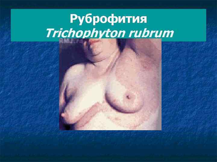 Руброфития Trichophyton rubrum 